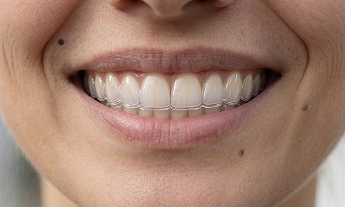 Мужчина надевает прозрачные элайнеры для исправления прикуса