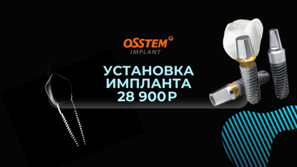 Импланты Osstem под ключ 28 900 руб.